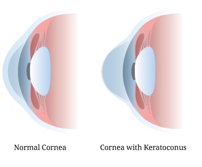 For-Sight Ophthalmics